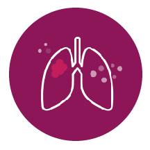 Cáncer de pulmón de
células no pequeñas (CPCNP)