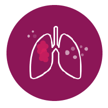 Cáncer de pulmón de
células pequeñas (CPCP)