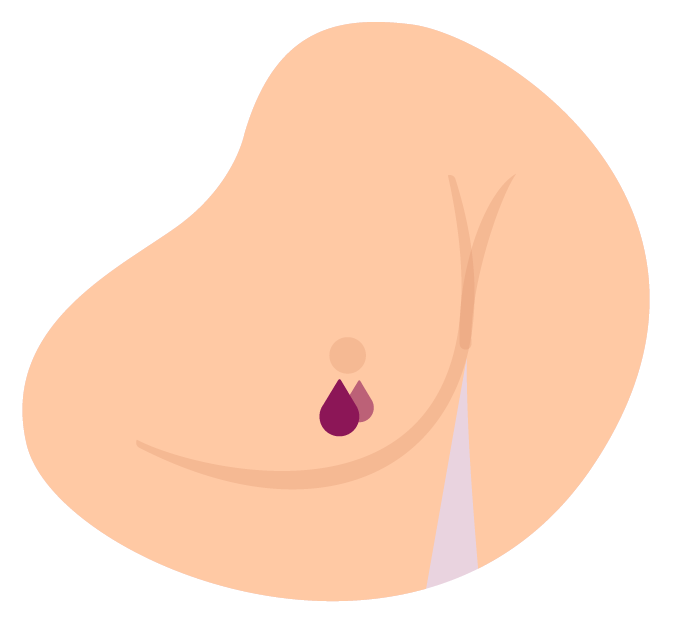 Secreción del pezón. Puede ocurrir en solo uno de los senos y puede tener secreción sanguinolenta.