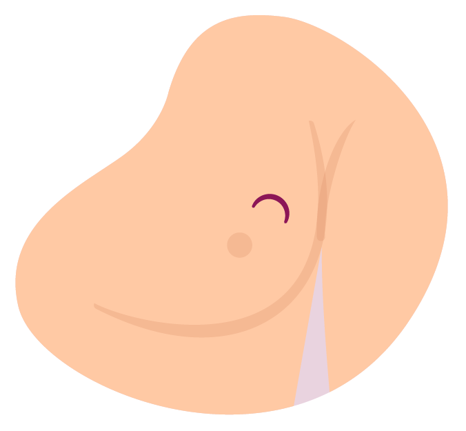 Protuberancia en el seno.